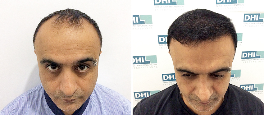 DHI before & after hair transplant results